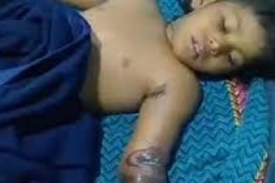 कोरबा की एक चार साल की मासूम बच्ची बिजली के झटके से झुलस गई