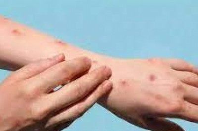 दुनियाभर में तेजी से बढ़ रहे मंकीपॉक्स के मामले,WHO ने बताया- कितना है खतरनाक ये बीमारी